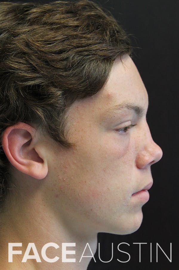 Rhinoplasty Before & After Gallery - Patient 26211156 - Image 1