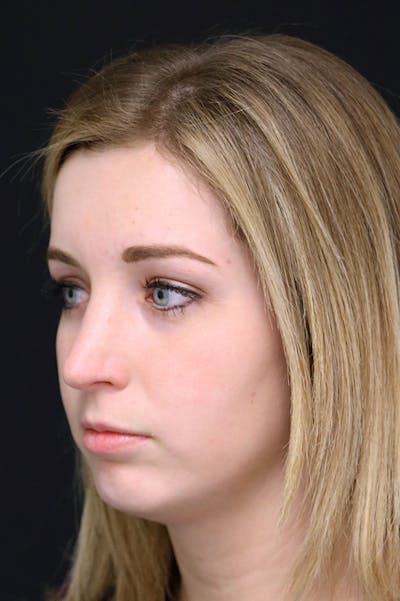 Rhinoplasty Before & After Gallery - Patient 26211154 - Image 4