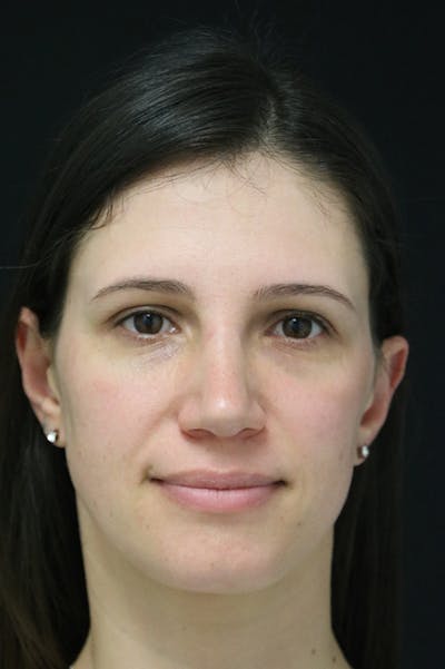 Rhinoplasty Before & After Gallery - Patient 26211153 - Image 6