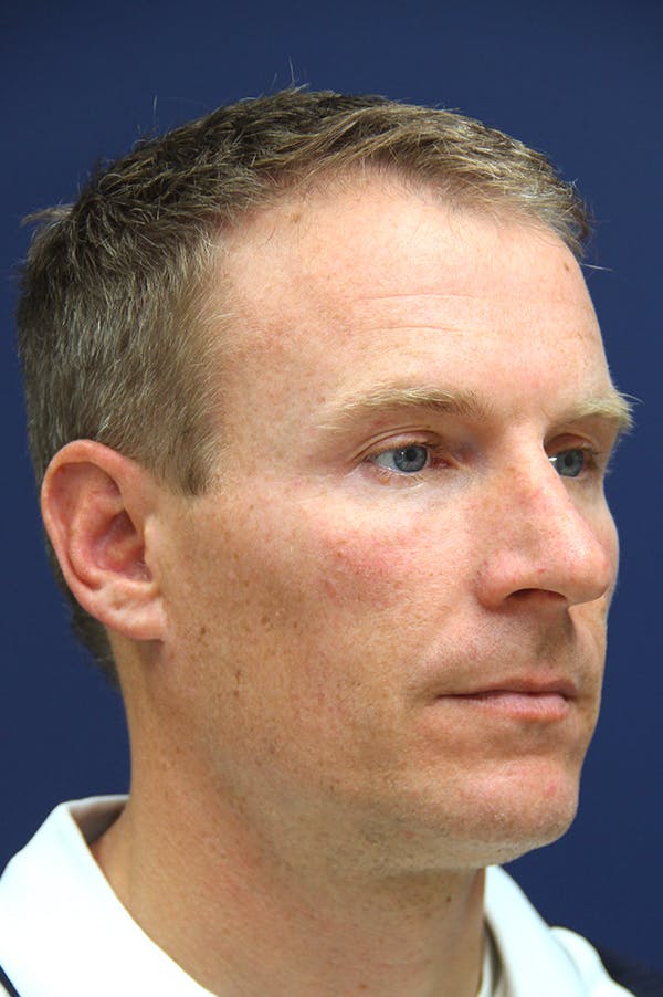 Rhinoplasty Before & After Gallery - Patient 26211155 - Image 3