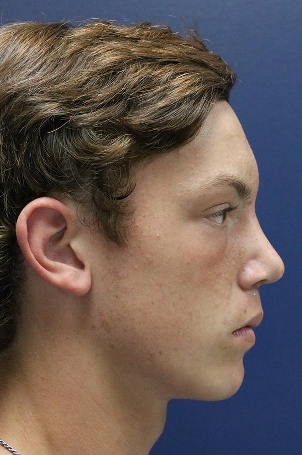 Rhinoplasty Before & After Gallery - Patient 26211156 - Image 2