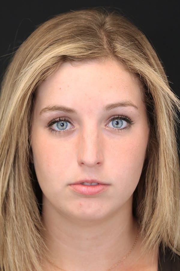 Rhinoplasty Before & After Gallery - Patient 26211154 - Image 5