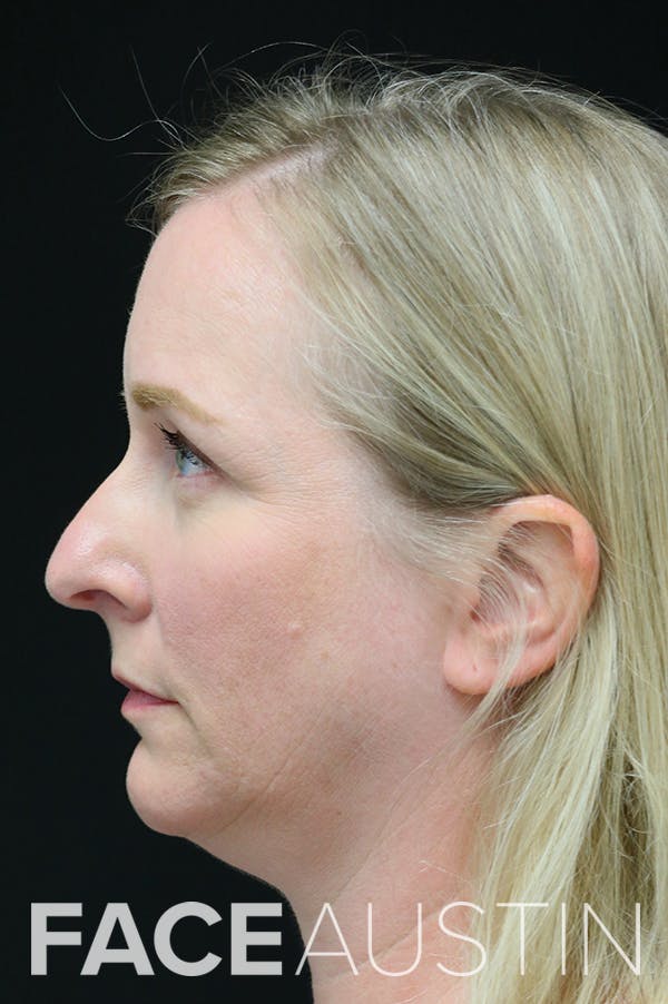 Rhinoplasty Before & After Gallery - Patient 26211157 - Image 1