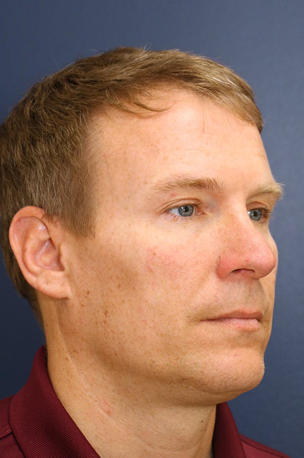 Rhinoplasty Before & After Gallery - Patient 26211155 - Image 4