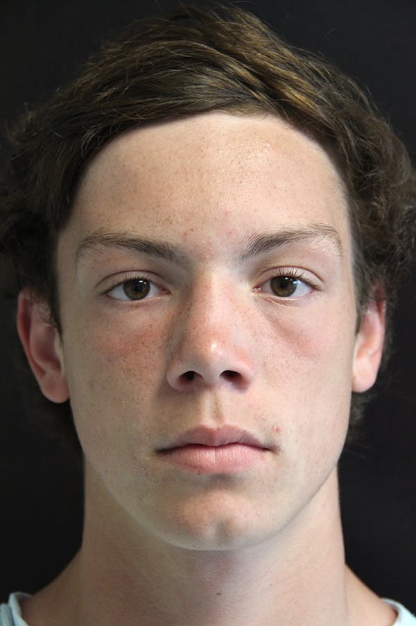 Rhinoplasty Before & After Gallery - Patient 26211156 - Image 3