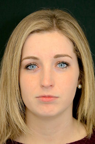 Rhinoplasty Before & After Gallery - Patient 26211154 - Image 6