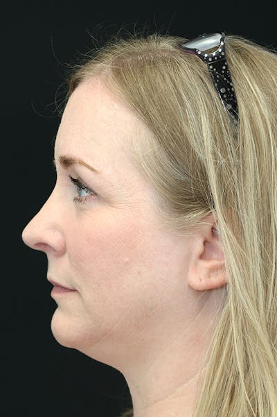 Rhinoplasty Before & After Gallery - Patient 26211157 - Image 2