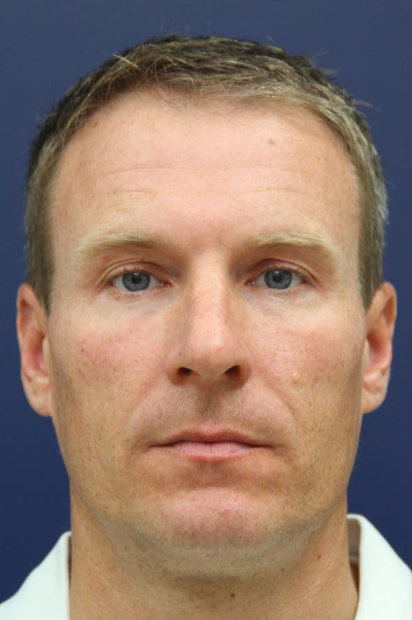 Rhinoplasty Before & After Gallery - Patient 26211155 - Image 5