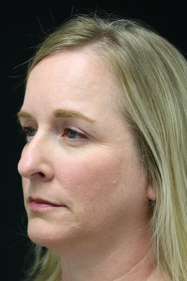 Rhinoplasty Before & After Gallery - Patient 26211157 - Image 3