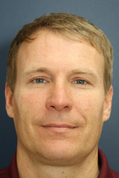 Rhinoplasty Before & After Gallery - Patient 26211155 - Image 6