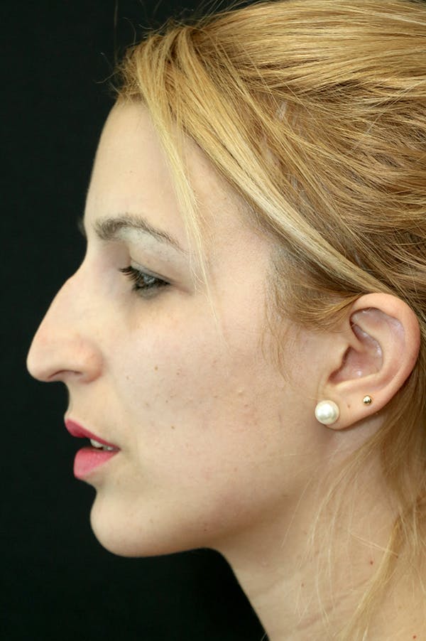 Rhinoplasty Before & After Gallery - Patient 26211158 - Image 1