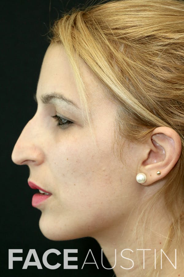 Rhinoplasty Before & After Gallery - Patient 26211158 - Image 1