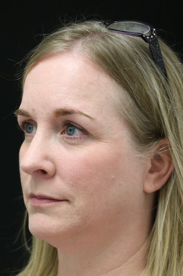 Rhinoplasty Before & After Gallery - Patient 26211157 - Image 4