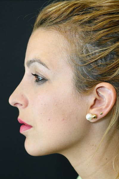 Rhinoplasty Before & After Gallery - Patient 26211158 - Image 2