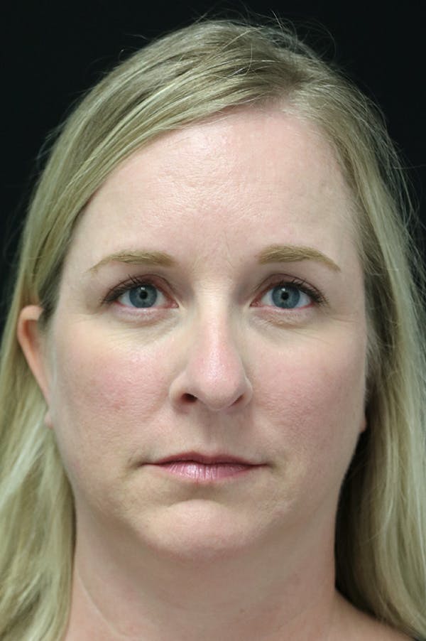Rhinoplasty Before & After Gallery - Patient 26211157 - Image 5