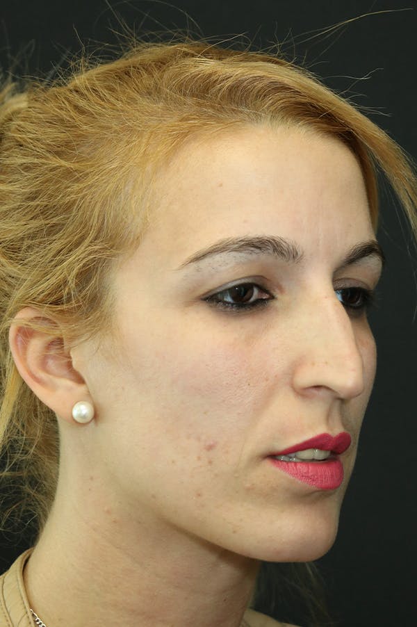 Rhinoplasty Before & After Gallery - Patient 26211158 - Image 3