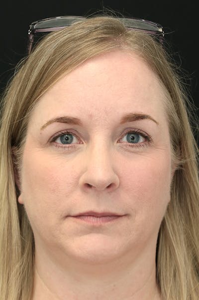 Rhinoplasty Before & After Gallery - Patient 26211157 - Image 6
