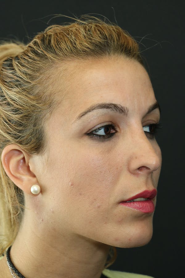 Rhinoplasty Before & After Gallery - Patient 26211158 - Image 4