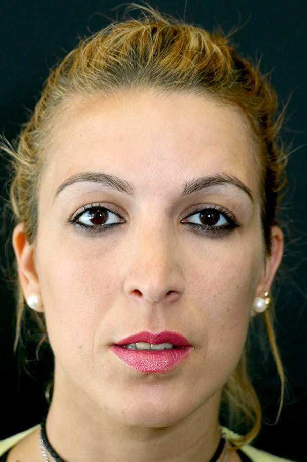 Rhinoplasty Before & After Gallery - Patient 26211158 - Image 6