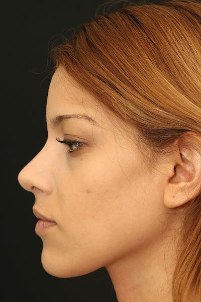 Rhinoplasty Before & After Gallery - Patient 26211159 - Image 2