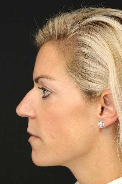 Rhinoplasty Before & After Gallery - Patient 26211160 - Image 1