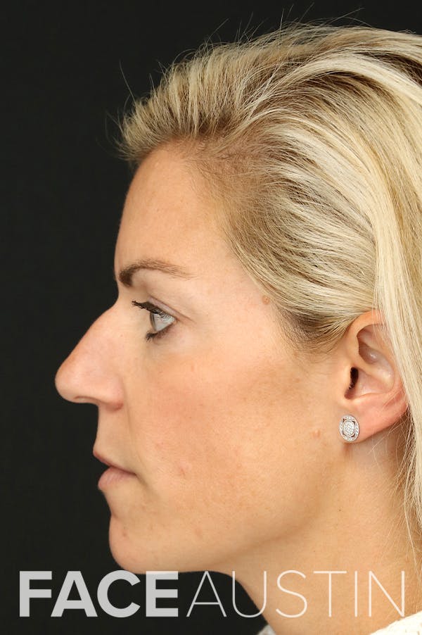 Rhinoplasty Before & After Gallery - Patient 26211160 - Image 1