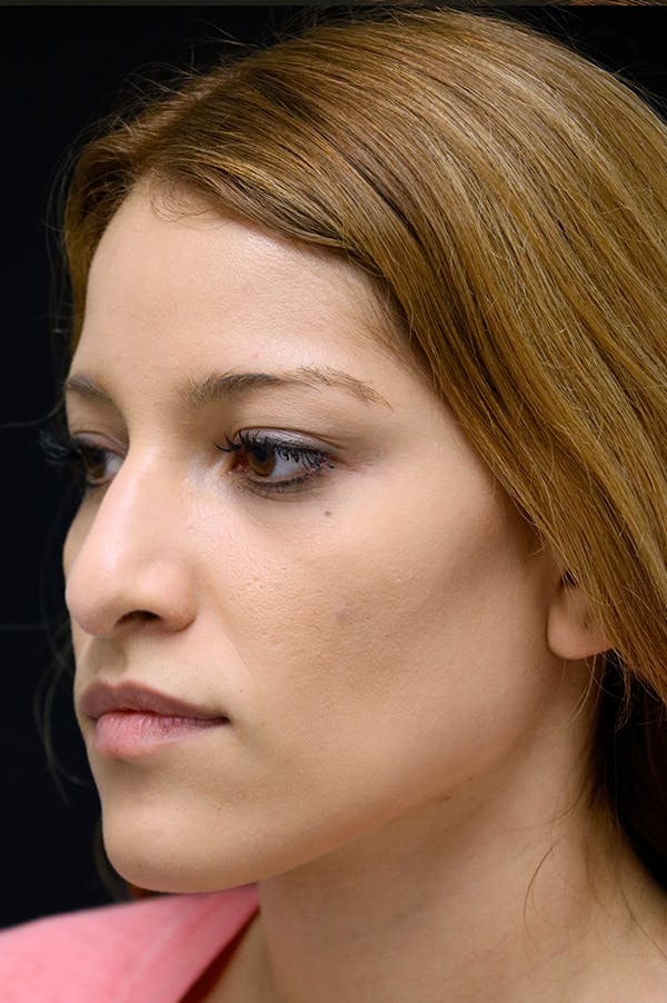 Rhinoplasty Before & After Gallery - Patient 26211159 - Image 3