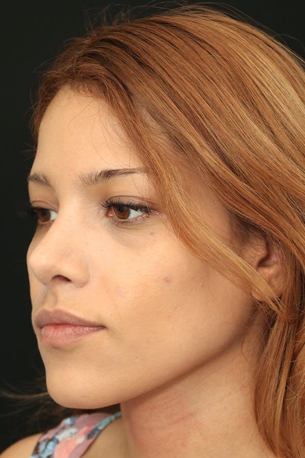 Rhinoplasty Before & After Gallery - Patient 26211159 - Image 4