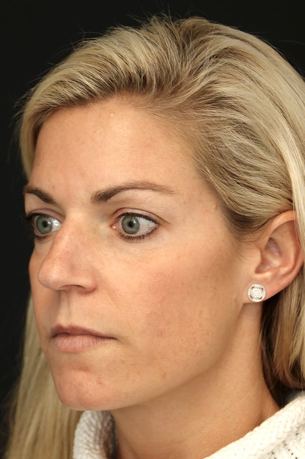Rhinoplasty Before & After Gallery - Patient 26211160 - Image 3