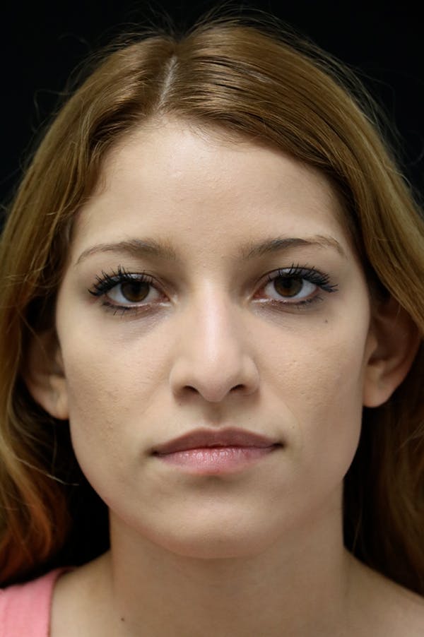 Rhinoplasty Before & After Gallery - Patient 26211159 - Image 5