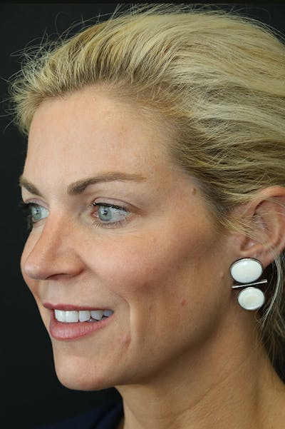 Rhinoplasty Before & After Gallery - Patient 26211160 - Image 4