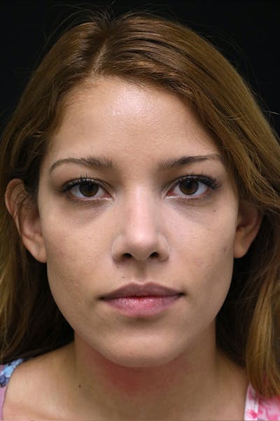 Rhinoplasty Before & After Gallery - Patient 26211159 - Image 6