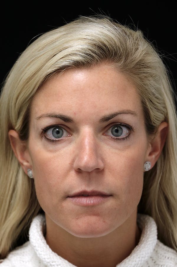 Rhinoplasty Before & After Gallery - Patient 26211160 - Image 5
