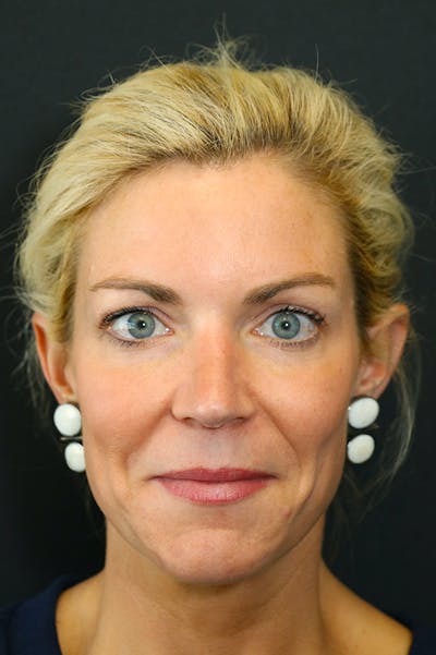 Rhinoplasty Before & After Gallery - Patient 26211160 - Image 6