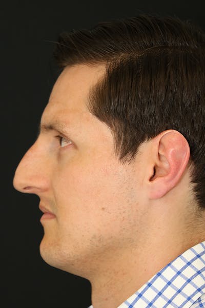 Rhinoplasty Before & After Gallery - Patient 26211161 - Image 1
