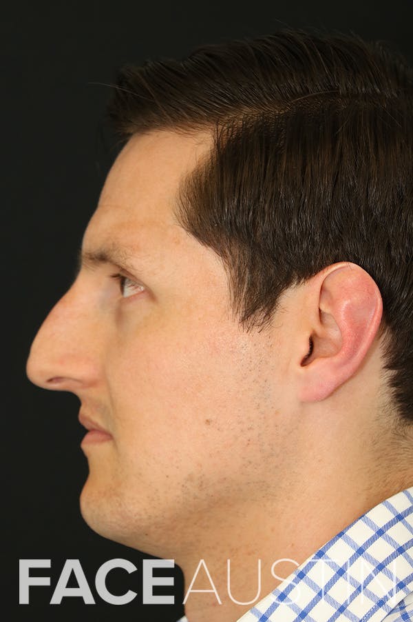 Rhinoplasty Before & After Gallery - Patient 26211161 - Image 1