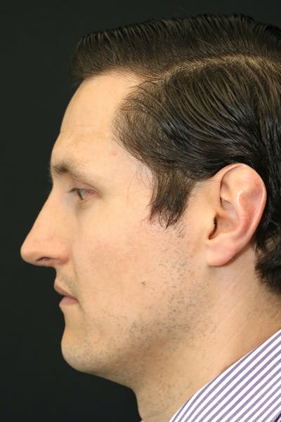 Rhinoplasty Before & After Gallery - Patient 26211161 - Image 2