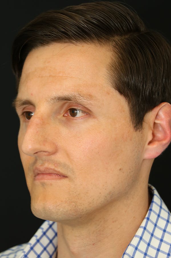 Rhinoplasty Before & After Gallery - Patient 26211161 - Image 3