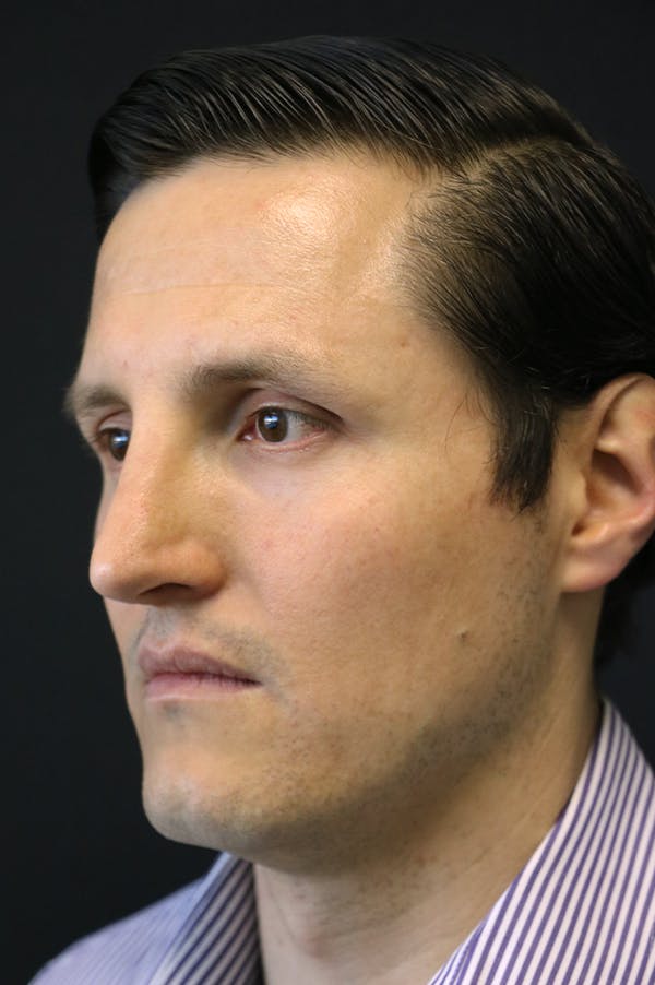 Rhinoplasty Before & After Gallery - Patient 26211161 - Image 4