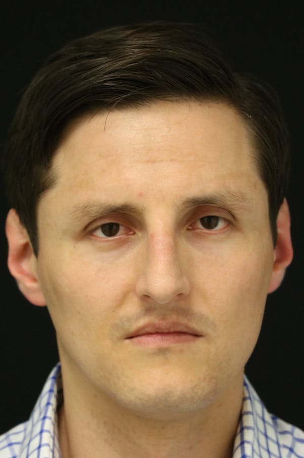 Rhinoplasty Before & After Gallery - Patient 26211161 - Image 5