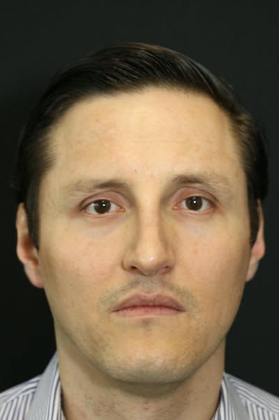 Rhinoplasty Before & After Gallery - Patient 26211161 - Image 6