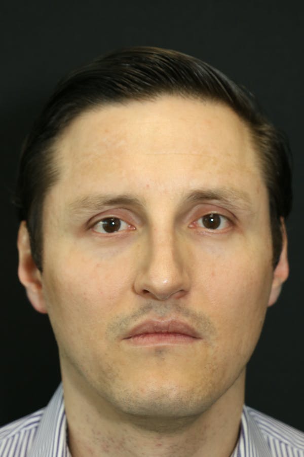 Rhinoplasty Before & After Gallery - Patient 26211161 - Image 6