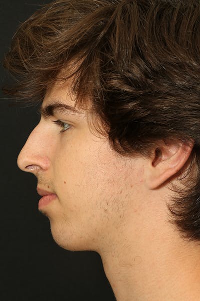 Rhinoplasty Before & After Gallery - Patient 26211162 - Image 1