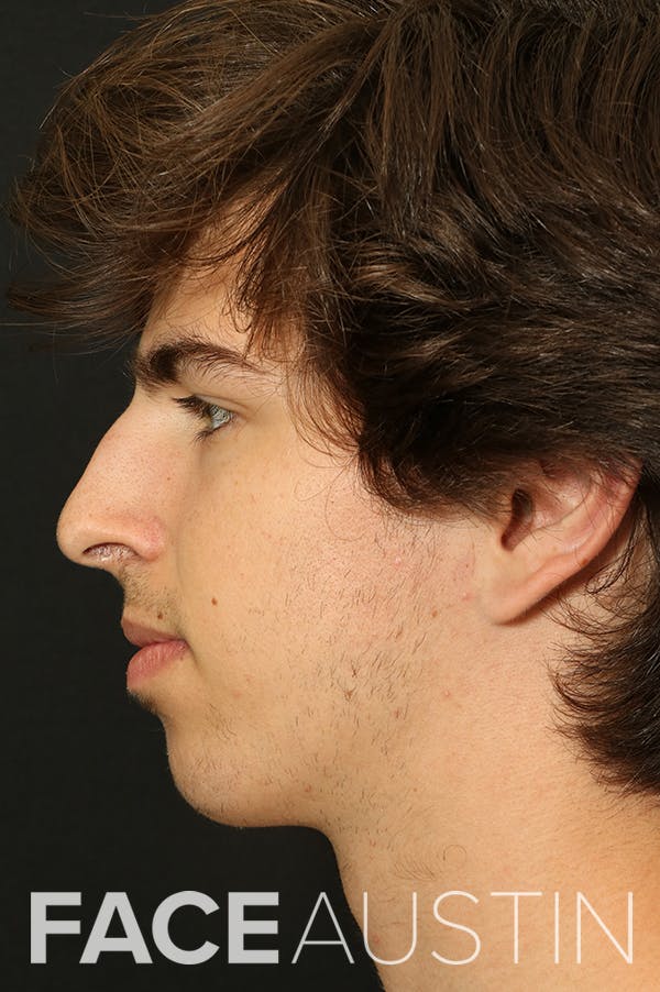 Rhinoplasty Before & After Gallery - Patient 26211162 - Image 1