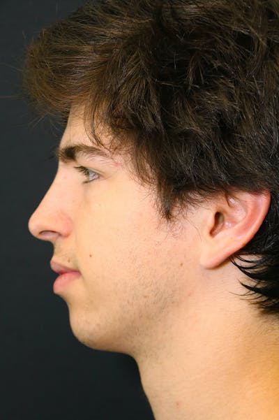Rhinoplasty Before & After Gallery - Patient 26211162 - Image 2