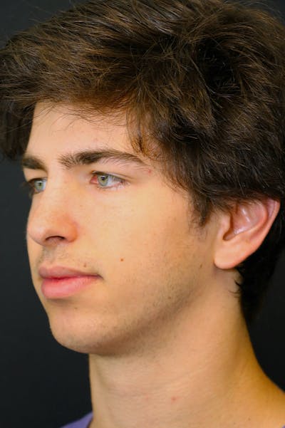 Rhinoplasty Before & After Gallery - Patient 26211162 - Image 4