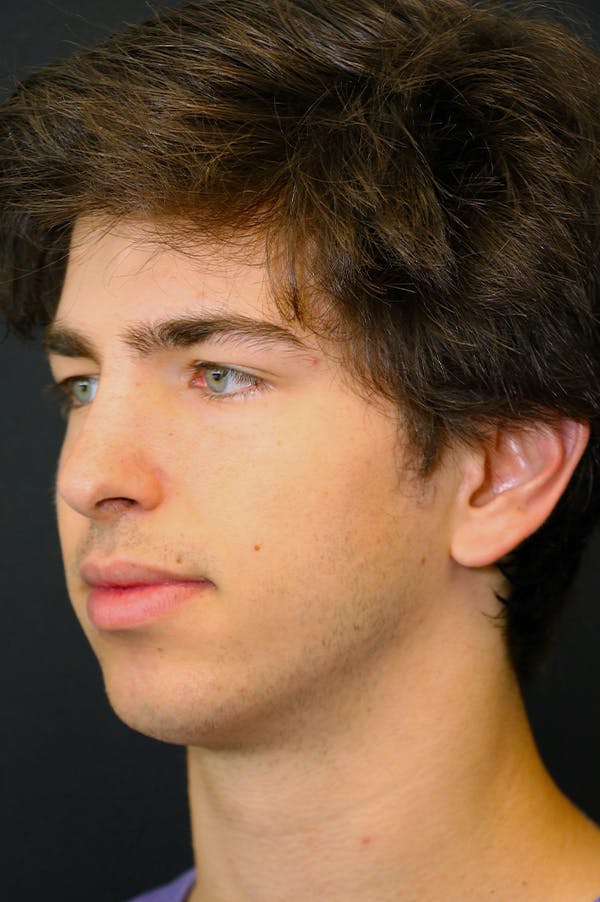 Rhinoplasty Before & After Gallery - Patient 26211162 - Image 4