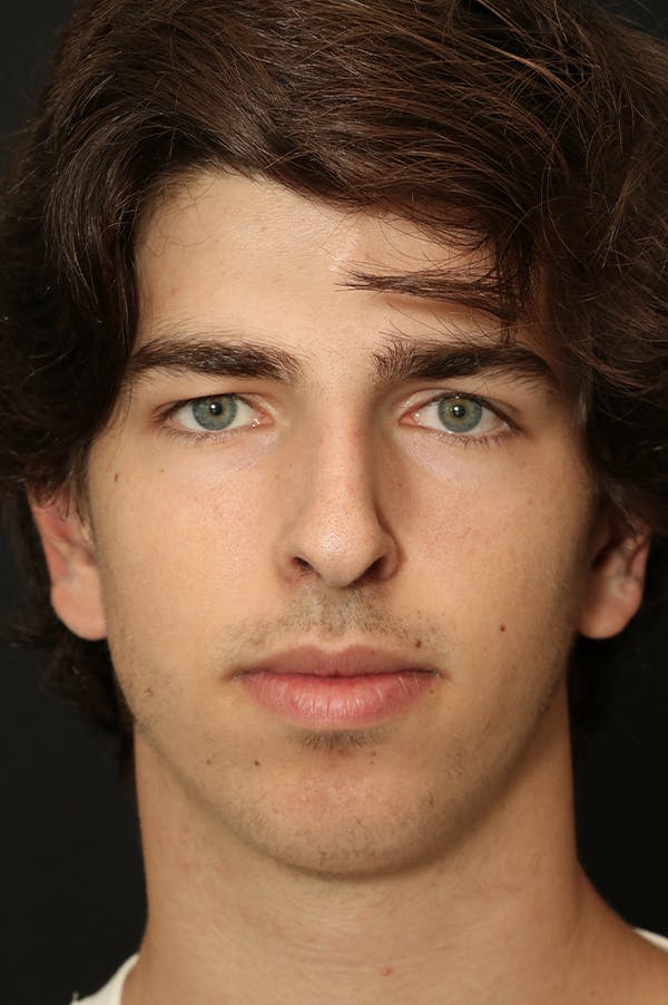 Rhinoplasty Before & After Gallery - Patient 26211162 - Image 5