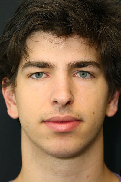 Rhinoplasty Before & After Gallery - Patient 26211162 - Image 6