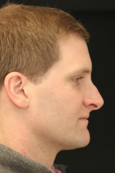 Rhinoplasty Before & After Gallery - Patient 26211163 - Image 1